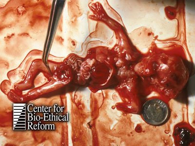 aborted baby 1st tri 2